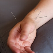 Acupuncture in Milton