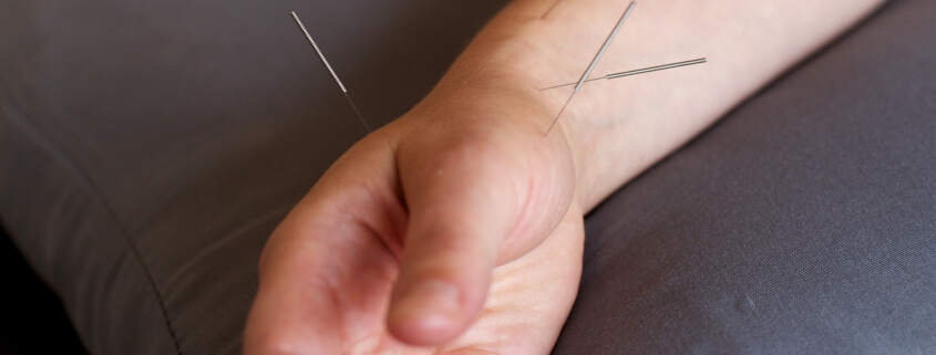 Acupuncture in Milton