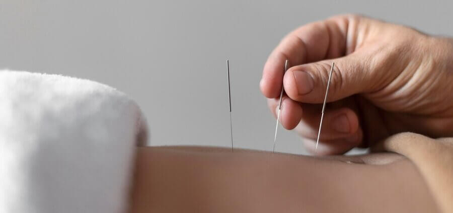 Acupuncture Therapy in Milton